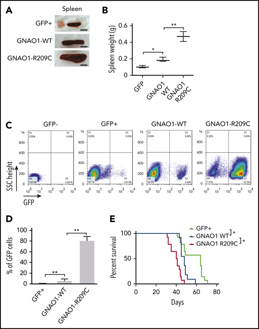 GNAO1 R209C mutation promotes ETV6-RUNX1+ leukemogenesis. (A) Representative images of the effects of ectopic expression of GNAO1 WT or R209C mutant on mouse spleen size at days 32 to 35 after injection. Reh cells expressing WT GNAO1, the R209C mutation, or a GFP control (GFP+) were injected into recipients through the tail vein. GFP−, negative GFP cell control. Images represent the results of 5 mice per group of 3 independent experiments. Scale bars, 1 cm. (B) Quantification of spleen weight in panel A. (C) Flow cytometry analysis of BM infiltration at days 32 to 35 after injection. (D) Quantification of BM infiltration in panel C. (E) Kaplan-Meier analyses of survival curves. Median survival (days): GFP+, 64; WT, 48; R209C, 40.5 (n = 15). Data are representative of 3 independent experiments with similar results. *P < .05, by log-rank test. (B,D) Data are expressed as the mean ± SD. *P < .05; **P < .01, by 2-tailed Student t test.