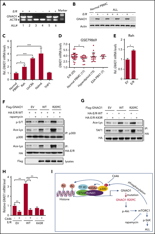 Reciprocal activation of E/R fusion and the GNAO1 R209C mutation induces leukemogenesis. (A) RT-PCR analysis of GNAO1 upregulation in ETV6-RUNX1 (E/R)+ clinical ALL specimens. ACTB was used as a control. (B) WB analysis of GNAO1 expression in normal PBMCs, E/R+, and E/R− childhood ALL specimens. (C) qRT-PCR analysis of GNAO1 mRNA expression in normal PBMCs, Reh, UoCB6, Nalm6, and THP1 leukemia cells. (D) The expression level of GNAO1 mRNA was significantly higher in E/R+ALL than in normal PBMCs. Expression data of GNAO1 mRNA were downloaded from the GSE79869 data set and analyzed. (E) qRT-PCR analysis of the effect of ectopic expression of the E/R fusion or an EV control on GNAO1 expression. (F) IP and WB analysis of the effects of rapamycin treatment on p300 acetylation (Ace-Lys), p300 serine/threonine phosphorylation (p-S/T), and E/R acetylation stimulated by ectopic expression of GNAO-1 WT or R209C mutation in Reh cells. (G) The K43R mutation of RUNX1 in E/R fusion inhibits E/R acetylation and association with TAF-1 stimulated by overexpression of GNAO1 WT or R209C mutant in Reh cells. (H) Treatment with the p300 inhibitor C464 reduces GNAO1 upregulation by E/R. (I) A hypothetical model showing how GNAO1 R209C mutation and E/R fusion cooperate to induce leukemia. Data are representative of 3 independent experiments with similar results. (C-E,H) Data are expressed as the mean ± SD. *P < .05; **P < .01; ***P < .001, by 2-tailed (C,E,H) or 1-tailed (D) Student t test.