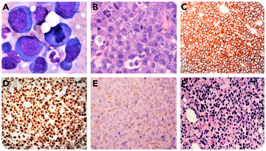 A 67-year-old HIV-negative man presented with a history of sinus lesions and elevated serum monoclonal immunoglobulin G kappa but no evidence of lytic bone lesions. Serum calcium, creatinine, and complete blood count were normal. Peripheral blood smear was unremarkable. A bone marrow workup showed normocellularity with trilineage hematopoiesis and partial involvement by an abnormal population of large cells that exhibited amphophilic cytoplasm, oval nuclei, and variably prominent nucleoli (panel A: Wright-Giemsa stain, original magnification ×1000; panel B: hematoxylin and eosin stain, original magnification ×400). By immunohistochemistry, these abnormal cells were positive for CD138 (panel C; original magnification ×200), MUM1 (panel D; original magnification ×200), CD56, C-MYC with kappa restriction, negative for PAX5 (panel E; original magnification ×200), CD20, CD45, CD30, CD117, cyclin D1, BCL-2, BCL-6, HHV8, and ALK1. Epstein-Barr (virus)–encoded RNAs (EBERs) were positive by in situ hybridization (panel F; original magnification ×200). The proliferation index by Ki-67 immunostaining approached 95%. C-MYC translocation was demonstrated by fluorescence in situ hybridization (FISH), but no other myeloma-associated chromosomal abnormalities were detected by FISH. A diagnosis of plasmablastic lymphoma (PBL) was rendered. Similar features were seen in his sinus mass.
