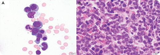 A 65-year-old man was diagnosed with immunoglobulin G lambda (IgG lambda) plasma cell myeloma in July 2019 with 70% involvement of bone marrow. He was positive for t(11;14) via fluorescent in situ hybridization (FISH) cytogenetics testing, and he had immunoglobulin heavy chain (IgH) gene rearrangement and 4 copies of Tp53. He received induction therapy with bortezomib, lenalidomide, dexamethasone and maintenance therapy with dexamethasone, and he also had an autologous stem cell transplantation in December 2019. He underwent bone marrow biopsy during a 3-month posttransplant follow-up. The peripheral blood showed mild normocytic normochromic anemia, thrombocytopenia, and rare scattered plasma cells. The bone marrow aspirate showed scattered abnormal plasma cells, several of which had irregular or convoluted nuclei and delicate blue cytoplasm with vacuoles (panel A, 400× objective). The core biopsy showed sheets of abnormal plasma cells, many of which had convoluted or horseshoe-shaped nuclei (panel B, 1000× objective). These cells stained positive for CD138 and CD56 and were negative for CD20 and CD30. The FISH cytogenetics panel was positive for t(11;14) with extra copies of the IgH gene.