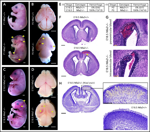Hemorrhage in Nfe2−/− mice occurs in utero. (A) P1 Nfe2+/+ and Nfe2−/− pups born by natural delivery. Yellow arrows point to representative head and body bleeds seen in the Nfe2−/− mice (Nfe2+/+, n = 8; Nfe2−/−, n = 13). Scale bars, 1 mm. (B) P0 Nfe2+/+ and Nfe2−/− dissected brains. Yellow arrows point to bleeds in both frontal lobes. Scale bars, 1 mm. (C) E18.5 Nfe2+/+ and Nfe2−/− mice delivered by caesarean section. Yellow arrows point to bleeds. Scale bars, 1 mm. (D) E18.5 Nfe2+/+ and Nfe2−/− dissected brains. Yellow arrows point to frontal and ventricle bleeds in the Nfe2−/− pups. Scale bars, 1 mm. (Ei-ii) Tables comparing the percentage of bleeds between E18.5 Nfe2+/+ pups (Nfe2+/+ n = 10, Nfe2−/− n = 10) and P0 Nfe2−/− pups (Nfe2+/+ n = 8, Nfe2−/− n = 13). (F-G) Histologic analysis demonstrates multiple bleed types present in the E18.5 Nfe2−/− dissected brains, but not in the Nfe2+/+ brain. Representative bleeds are shown in the cerebral cortex along with periventricular and intraventricular bleeds. Scale bars, 500 µm (F); 100 µm (G). (H) Nissl staining of E18.5 Nfe2−/− (n = 3) coronal brain section and the corresponding region in the Nfe2+/+ brain (n = 3). Scale bar, 500 µm (inset, 200 µm).