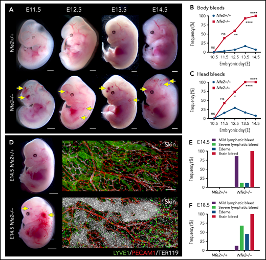 Cerebral hemorrhage in Nfe2−/− mice occurs as early as E11.5 and persists through development. (A) Representative images of Nfe2−/− and age-matched Nfe2+/+ control embryos at E11.5 (Nfe2+/+ n = 16; Nfe2−/− n = 25), E12.5 (Nfe2+/+ n = 13; Nfe2−/− n = 18), E13.5 (Nfe2+/+ n = 16; Nfe2−/− n = 14), and E14.5 (Nfe2+/+ n = 14; Nfe2−/− n = 14). Scale bars, 1 mm. (B-C) Scored bleeding phenotypes in the Nfe2+/+ and Nfe2−/− embryo body (B) or head (C) from E10.5 to E14.5. (D) Bleeding into the lymphatic sacs and lymphatic vessels is seen at E14.5 in the Nfe2−/− but not in the Nfe2+/+ mice. Immunofluorescence staining of E14.5 Nfe2+/+ skin showing that erythrocytes (TER119, white) are restricted to the blood vessels (PECAM1, red), whereas erythrocytes are readily detected within dilated lymphatic vessels (LYVE1, green) in Nfe2−/− mice. Embryo scale bars, 2 mm. Skin confocal scale bars, 100 µm. (E-F). Frequency of bleed types at E14.5 (Nfe2+/+ n = 14; Nfe2−/− n = 12) (E) and E18.5 in Nfe2+/+ (n = 10) and Nfe2−/− embryos (n = 10) (F). Scale bars for whole embryos, 1 mm; scale bars for skin, 150 μm. Contingency table analysis was performed using the 2-tailed χ2 test for the comparison of bleed frequencies (B-C). *P < .05; ****P < .0001. ns, not significant.