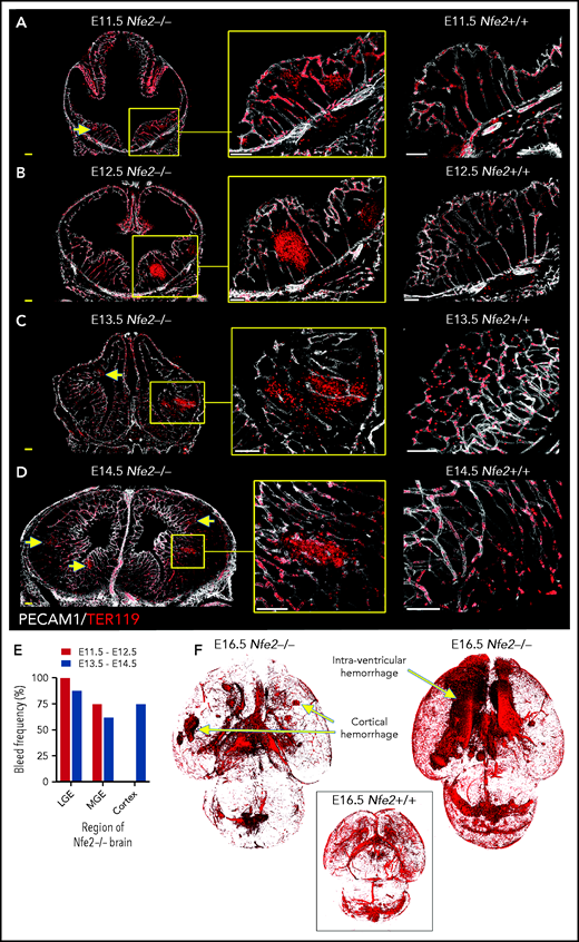 ICH first occurs in the ganglionic eminence and progresses to ventricle and cortical involvement. (A-D) Representative confocal images from thick sections of Nfe2+/+ (n = 3 per stage) and Nfe2−/− (n = 3 per stage) brains at (A) E11.5, (B) E12.5, (C) E13.5, and (D) E14.5. Sites of ICH are indicated by yellow arrows. TER119 (red), erythrocytes; PECAM1 (white), cerebral vasculature. Scale bars for E11.5 to E13.5, 150 μm; inset, 50 μm; scale bars for E14.5, 200 μm; inset, 50 μm . (E) Summary of hemorrhage types between E11.5 and E12.5 (n = 5) and between E13.5 and E14.5 (n = 8) scored from vibratome cut coronal brain sections. LGE, lateral ganglionic eminence, MGE, medial ganglionic eminence. (F) Light sheet microscopy showing spatial location of hemorrhage in the E16.5 Nfe2−/− embryos, including multiple cerebral bleeds and large ventricle hemorrhage (n = 2). No bleeds can be seen in the E16.5 Nfe2+/+ brain control (n = 2).