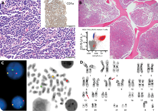 A 25-year-old man presented with a leukocyte count of 174 × 109/L, massive splenomegaly, inguinal lymphadenopathy, night sweats, weight loss, and early satiety for 1 month. The peripheral blood smear revealed marked absolute left-shifted neutrophilia, eosinophilia, and basophilia with flow cytometric detection of 1.3% aberrant myeloblasts and 0.01% immature T cells by minimal residual disease analysis (panel B, inset). The inguinal lymph node biopsy showed diffuse sheets of medium lymphoid cells that stained positive for CD1a and terminal deoxynucleotidyltransferase (panel A, hematoxylin and eosin (H&E) stain, original magnification ×400; inset, original magnification ×100 ). The concurrent flow cytometry analysis confirmed involvement by T-lymphoblastic leukemia/lymphoma. The bone marrow examination showed a hypercellular marrow with left-shifted myeloid and megakaryocytic hyperplasia, with 1% blasts (panel B, H&E stain, original magnification ×100 ). An FGFR1 (8p11) gene rearrangement was detected in the lymph node (85% of cells) and bone marrow (95% of cells) (panel C; break apart FISH with red-31FGFR1, green-51 FGFR1, and yellow fusion signals) by fluorescence in situ hybridization analysis and was negative for BCR-ABL1. Cytogenetics revealed t(8;13) in the bone marrow (panel D).