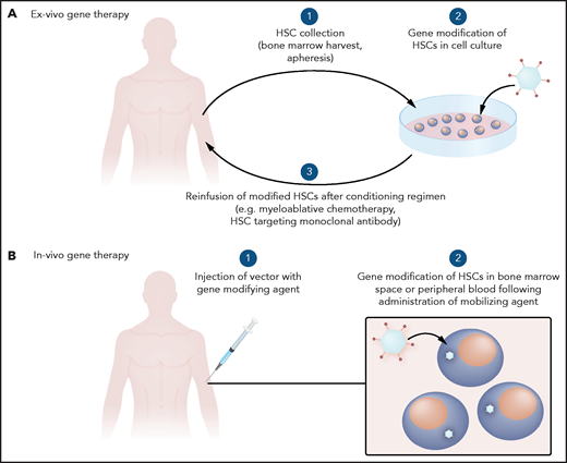 General schema for gene therapy. (A) Ex vivo therapy involves collection of HSCs to be gene modified and reinfused after a conditioning regimen. (B) In vivo gene therapy involves systemic delivery of a gene-modifying agent with trophism for HSCs.