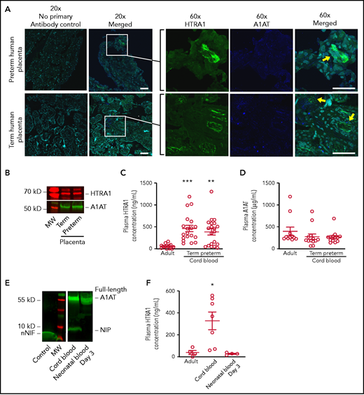 The human placenta expresses both HTRA1 and A1AT, and umbilical cord blood NIP levels correlate with plasma HTRA1 levels after birth. (A) Human placental tissue from both term and preterm gestations was subjected to immunofluorescence studies using primary antibodies targeting HTRA1 (green) and the C-terminus of A1AT (blue). DAPI was used as a nuclear counterstain (aqua). (Both 20× and 60× objectives were used; scale bars, 50 μm.) These images are representative of experiments performed by using 3 different placental samples from each group. Yellow arrows indicate juxtaposition of A1AT and HTRA1. (B) We further determined placental HTRA1 (red) and A1AT (green) protein expression via western blotting in placental extracts from both term and preterm gestations. The western blot is representative of 3 separate experiments in each group. We next assessed plasma concentrations of both HTRA1 and A1AT in plasma isolated from healthy adults and umbilical cord blood isolated from both healthy term neonates and preterm neonates. (C) The y-axis depicts plasma HTRA1 concentration ± SEM for adult plasma, term umbilical cord blood plasma, and preterm umbilical cord blood plasma. (D) The y-axis depicts plasma A1AT concentration ± SEM for adult plasma, term umbilical cord blood plasma, and preterm umbilical cord blood plasma. (E) Umbilical cord blood plasma and peripheral blood taken from the same neonate 3 days after delivery were subjected to western blotting using a primary antibody to detect the C-terminus of A1AT (green). nNIF, another NIP, was used as a positive control (Control). This western blot is representative of 3 separate experiments using plasma samples from 3 different neonates. (F) The plasma concentration was determined of HTRA1 in adult peripheral blood plasma, umbilical cord blood plasma, and plasma from neonates 3 days after birth. The y-axis depicts plasma HTRA1 concentration ± SEM. *P < .05 for umbilical cord blood vs both adult and day 3 neonatal plasma. **P < .01, ***P < .001. MW, molecular weight.