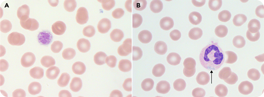 A 17-year-old girl presented with thrombocytopenia and menorrhagia. Her mother, maternal grandfather, and uncle also had thrombocytopenia. Peripheral counts revealed a platelet count of 88 × 109/L with unmeasured mean platelet volume. The peripheral blood smear (panels A-B; original magnification ×100; Wright-Giemsa stain; normocytic red blood cells provide scale) demonstrated giant platelets in every other high-power field (panel A) and neutrophils with type I Döhle-like inclusions (panel B). A von Willebrand factor profile was normal. Targeted gene sequencing confirmed a pathogenic heterozygous missense mutation in myosin heavy chain 9 (MYH9) (NM_002473.5:c.3493C>T (p.Arg1165Cys); rs80338829). Menorrhagia was caused by dysfunctional uterine bleeding, and it resolved with tranexamic acid. This case highlights the role of microscopy in the evaluation of thrombocytopenia.