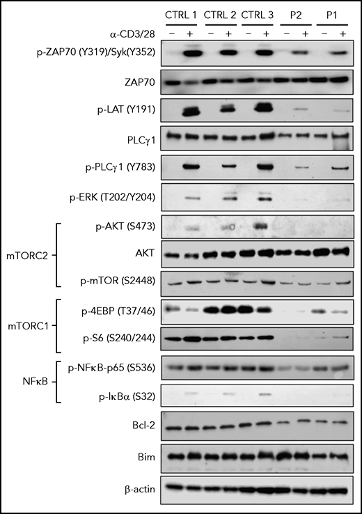 TCR signaling in SASH3-mutated patients. Immunoblots for the indicated proteins and phosphorylated proteins on lysates from 5 × 103 CD3+ T cells (obtained from PBMCs upon negative selection with magnetic beads) with (+) and without (–) stimulation with anti-CD3 and anti-CD28 Dynabeads for 20 minutes from 3 healthy controls and P1 and P2. β-actin was used as loading control.