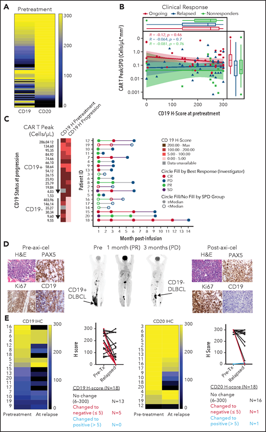 Association between CD19 levels at pretreatment or relapse and response. (A) Pretreatment CD19 H-score distribution in ZUMA-1 patients (N = 100) ordered by CD20 H-score: 90% CD19+, 93% CD20+, and 98% CD19+, and/or CD20+. CD19 and CD20 positivity was defined as H-score >5. (B) Association between pretreatment CD19 H-score with engraftment index (CAR T Peak/SPD) and clinical response. (C) Swimmer plot of relapse patients (N = 20) by CD19 status and peak CAR T-cell level. (D) Positron emission tomography scans and tumor biopsies from patient 21 at the indicated time points post–axi-cel. Brown staining shows positive signal from the respective immunohistochemistry marker with ×40 original magnification. Arrows show sites of tumor biopsy. (E) CD19 and CD20 H-scores in paired pretreatment-progression biopsies from relapsed patients (N = 18). CR, complete response; H&E, hematoxylin and eosin; PD, progressive disease; PR, partial response; SD, stable disease; SPD, sum of product of perpendicular diameters.