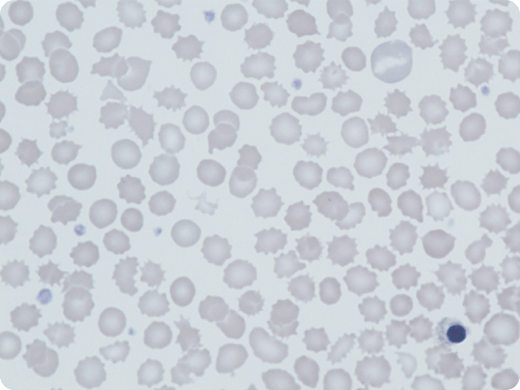 A 5-year-old boy presented with mild neonatal jaundice and hemolytic anemia; his laboratory tests revealed the following: hemoglobin (Hb), 99 g/L; reticulocytes, 19%; mean corpuscular volume (MCV), 71 fL; HbA2, 3.6%; and fetal Hb (HbF), 21%. His parents, from Pakistan, were distantly related; there was no family history of anemia. A blood film showed polychromasia and marked anisopoikilocytosis; in particular, acanthocytes, echinocytes, polychromasia, and occasional nucleated red cells were seen (May-Grünwald-Giemsa stain; original magnification ×100). Erythrocyte pyruvate kinase (PK) activity was low (1.8 IU/g Hb; normal, 13-17 IU/g Hb). Both parents had normal PK activity. A second male sibling had similar hematological findings. Hemolysis, low MCV, and high HbF levels were common features. Sequencing of α-globin, β-globin, and PKLR genes was normal in both brothers but a subsequent red cell gene panel showed that they were both homozygous for a novel Krüppel-like factor 1 (KLF1) variant, c.938G>T; p.Trp313Leu, likely pathogenic by American College of Medical Genetics and Genomics (ACMG) standards and guidelines. Both parents were heterozygous for this variant, which has never previously been described in any populations.