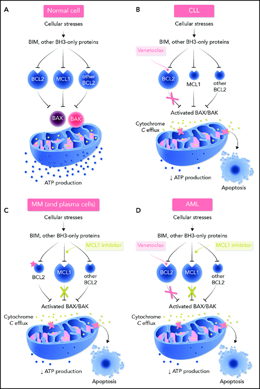 Regulation of the intrinsic (mitochondrial) pathway to apoptosis by the BCL2 protein family and mechanism of action of BH3 mimetics in normal cells and selected hematologic neoplasms. (A) In most normal cells, multiple prosurvival BCL2 proteins act to maintain their survival by preventing the activation of the cell death effectors BAX and BAK. Cellular stresses upregulate the BH3-only proteins (eg, BIM, BAD, PUMA, NOXA) that act by binding to BCL2 or its prosurvival relatives (MCL1, BCLxL, BCLw, BCL2A1). These interactions between BH3-only proteins and prosurvival proteins can be specific (eg, BAD only binds BCL2, BCLxL, and BCLW with high affinity; NOXA only binds MCL1 and BCL2A1) or more encompassing (eg, BIM and PUMA will bind all prosurvival proteins with high affinity).121 Tight binding of the BH3-only proteins blocks the ability of the prosurvival BCL2 proteins to hold BAX/BAK in check. The threshold for apoptosis is determined largely by the relative abundance of the key players and this varies according to cell lineage and microenvironmental cues. In many hematologic cancers, oncogenic stress-induced BH3-only protein activity means that the threshold for inducing apoptosis is low with the malignant cell being “primed for death” in some instances.2 (B) BCL2 expression is often dysregulated in CLL with high levels of expression and the leukemic cells are heavily reliant on BCL2.17,30,122 Hence, CLL cells are susceptible to the selective inhibition of BCL2 with venetoclax (in red). Inhibition of BCL2 by venetoclax allows activated BAX/BAK oligomers to form on the mitochondrial outer membrane, permeabilizing it and thereby compromising normal mitochondrial function (eg, reduced ATP production), as well as triggering the leakage of intramitochondrial molecules (eg, cytochrome c; green). These trigger the activation of proteolytic caspases that lead to cellular demolition. Because BAX/BAK are essential to drive MOMP, they are required for the action of venetoclax and all true BH3 mimetics. (C) In normal plasma cells and in many cases of multiple myeloma, especially relapsed disease, the predominant survival protein expressed is MCL1.7,117,123 Hence, MCL1 inhibition (in green) could well prove to be effective for this plasma cell malignancy. However, as indicated by the red asterisk, some subtypes of multiple myeloma are also highly susceptible to BCL2 inhibition (see Figure 2). (D) In AML, the degree of dependence on BCL2 or on MCL1 varies, with some subtypes being more BCL2 reliant than others (see Figure 2). Overall, both BCL2 and MCL1 appear to play prominent prosurvival roles in most AML cases. Loss of oxidative phosphorylation and energy production after MOMP is a prominent effect of venetoclax in AML cells.91,124 Professional illustration by Somersault18:24.