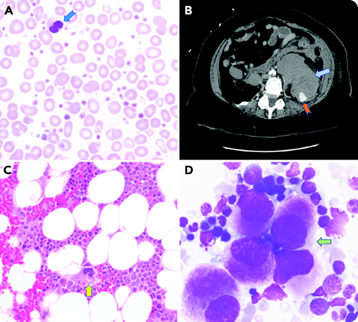 A 65-year-old woman underwent a bone marrow aspiration and biopsy of the left iliac crest for evaluation of macrocytic anemia and elevated platelet count of 1 257 000/μL (panel A: Wright-Giemsa stain; ×1000 magnification; anisopoikilocytosis; dysplastic bilobated neutrophil). After the procedure, she reported weakness in her left leg and severe pain around the site without external bleeding. A few hours later, she was found to have a blood pressure of 95/46 mmHg and a heart rate of 101 beats per minute. Repeat laboratory studies showed a decrease in hemoglobin from 7.8 g/dL before the procedure to 5.5 g/dL after the procedure along with acute renal failure. A computed tomography scan of the abdomen and pelvis showed a large retroperitoneal hemorrhage (RPH) with active intravascular contrast extravasation (panel B). She was resuscitated with red blood cell transfusions and embolization of the L4 lumbar artery. Biopsy results showed evidence of myelodysplastic/myeloproliferative neoplasm, unclassifiable, with hypercellular bone marrow and dysplastic megakaryocytes (panel C; hematoxylin and eosin stain; ×400 magnification; panel D; Wright-Giemsa stain ×1000 magnification). Molecular testing did not show JAK2, CALR, or MPL gene mutations. Acquired von Willebrand disease was ruled out.