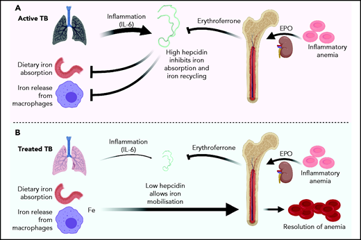 Proposed influences on iron homeostasis during active and treated TB. (A) Inflammatory anemia during active Mtb infection: IL-6 induces high levels of hepcidin, overriding the hepcidin-suppressive signal mediated by erythroferrone (Erfe), which is produced by erythroblasts in response to Epo signaling. High hepcidin concentrations block iron absorption and prevent iron release from iron-recycling macrophages, likely exacerbating inflammatory anemia. (B) Rapid resolution of inflammation following anti-TB treatment allows Erfe to suppress hepcidin, mobilizing sequestered iron and unblocking dietary iron absorption, contributing to resolution of inflammatory anemia. The figure was created with Biorender.com.