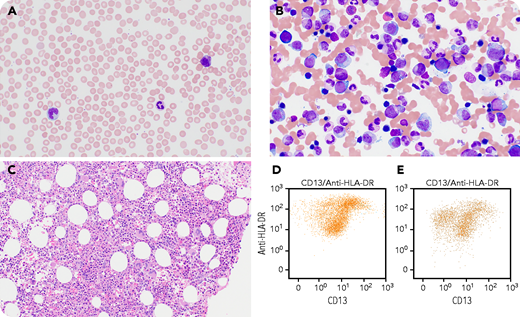 A 67-year-old man presented with increased fatigue, spontaneous bruising on his thighs, new inflammation of his wrist, relapsing polychondritis, and macrocytic anemia. The peripheral blood shows slight anisocytosis and left-shifted granulocytes with 10% myelocytes (panel A, peripheral blood smear, Wright-Giemsa stain, objective magnification 60×, total magnification ×600). Besides the occasional cytoplasmic vacuoles in myeloid cells identified in the bone marrow aspirate, bone marrow biopsy and aspirate show moderate hypercellularity with essentially normal trilineage hematopoiesis (panel B, bone marrow aspirate, Wright-Giemsa stain, objective magnification 60×, total magnification ×600; panel C, hematoxylin and eosin stain, objective magnification 20×, total magnification ×200). Flow cytometric immunophenotyping showed an atypical pattern of myeloid maturation (panel D, HLA-DR/CD13; panel E, normal pattern). Molecular analysis for UBA1 gene revealed a mutation (UBA1 c.121A>G, p.Met41Val), confirming the diagnosis of vacuoles, E1 enzyme, X-linked, autoinflammatory, and somatic (VEXAS) syndrome.