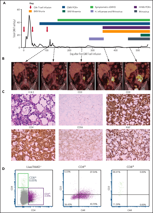 Patient 2 clinical summary, PET scans, and histological features of the CAR T-cell malignancy. (A) Timing of CAR T-cell infusions (red arrows), peripheral blood CAR T-cell quantitation (solid black line), chronic graft-versus-host disease (cGVHD), and infections (colored bars) over time. (B) PET scans showing the left para-aortic lymph node tumor seen from just prior to the third CAR T-cell infusion. (C) Morphology and immunohistochemical staining of tumor biopsy showing aberrant T cells with scanty cytoplasm and enlarged hyperchromatic nuclei, with low/negative CD3 and high CD2, CD4, and Ki67 with moderate CD56 staining. The Ki-67 proliferation index was 99%. The cells were negative for CD5, CD7, CD8, BCL-2, and CD10. Specific stains are shown above each image; original magnifications ×400 for H & E and ×50 for immunohistochemistry images. (D) Flow cytometry assessment of CAR expression on live T cells directly isolated from a biopsy of the para-aortic tumor showing that aberrant CD4+ T cells (purple) with reduced CD3 expression predominantly express CAR compared with a small CD8+ T-cell population (green) with normal CD3 expression and nil CAR expression. 7AAD, 7-amino actinomycin D; BKV, BK virus; CMV, cytomegalovirus; H. influenzae, Haemophilus influenzae; H&E, hematoxylin and eosin; HHV6, human herpesvirus 6; PCR, polymerase chain reaction.