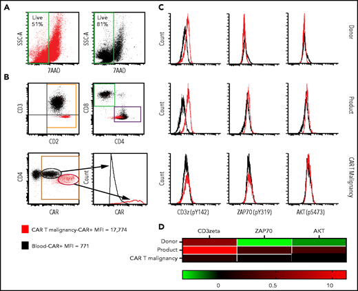 Flow cytometry assessment of cell-surface CAR expression in cultured malignant CAR T cells and assessment of basal activation of unstimulated malignant CAR T cells. (A) Viable cells in stimulated tumor-derived malignant CAR T-cell cultures (red) compared with blood-derived CAR T cells (black) at the end of 4-week culture. (B) Cultured tumor-derived CD3−, CD2high, CD4low malignant CAR T cells (red dots) showing high CAR expression compared with the mixed CD4+ and CD8+, CD3+ CAR T cells expanded from the peripheral blood (black dots) over 2 weeks. (C) Histograms showing phosphorylation levels of mediators of activation in unstimulated CD4+ T cells from untransduced donor PBMC (donor, top row), the CAR T-cell product (product, middle row), and directly isolated malignant CAR T cells (CAR T malignancy, bottom row). Histograms from samples stained with the phosphor-specific antibody (red lines) were compared with fluorescence minus one (FMO) samples (black lines) stained with surface antibodies only. (D) Heat map of relative phosphorylation status of CD3ζ, ZAP70, and AKT in different conditions corrected for autofluorescence using the resolution metric (RD), where RD = (MFIstained − MFIFMO)/(rSDstained + rSDFMO). MFI, median fluorescent intensity; rSD, robust standard deviation; SSC-A, side scatter area.