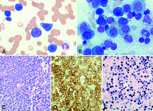 A 73-year-old man with a 2-year history of bilateral lung transplantation presented with progressive fatigue, nausea, and night sweats over the past 2 months. Laboratory tests showed abnormal serum components: creatinine, 460.0 µmol/L; lactate dehydrogenase, 3073 U/L; immunoglobulin A (IgA) lambda paraprotein, 43.7 g/L; free gamma light chain, 8.2 g/L; and Epstein-Barr virus (EBV) load, 1 555 723 IU/mL. Complete blood cell count demonstrated leukocytes 13.7 × 109/L, hemoglobin 74 g/L, and platelets 59 × 109/L. Blood smear examination showed 34% blastoid cells (panel A: Wright-Giemsa stain, original magnification ×1000) that were identified as plasma cells with aberrant CD56 and absent CD19 and CD20 by flow cytometry. Bone marrow biopsy revealed markedly increased large cells with plasmablastic morphology (panel B: aspirate smear, Wright-Giemsa stain, original magnification ×1000; panel C: core biopsy, hematoxylin and eosin stain, original magnification ×400) that were positive for CD138 (panel D: original magnification ×400), lambda light chain restriction, and EBV latency 1 infection (panel E: EBV-encoded RNA in situ hybridization, original magnification ×400). Cytogenetic studies detected a complex karyotype that included t(8;14)(q24;q32)/MYC-IGH. A radiologic scan demonstrated no lymphadenopathy or bone lytic lesions. Thereafter, diagnosis of a plasmablastic myeloma/leukemia variant of monomorphic posttransplant lymphoproliferative disorder (M-PTLD) was rendered. The patient’s condition deteriorated without therapy specifically designated for treating myeloma/lymphoma, and he expired 7 days after the diagnosis.
