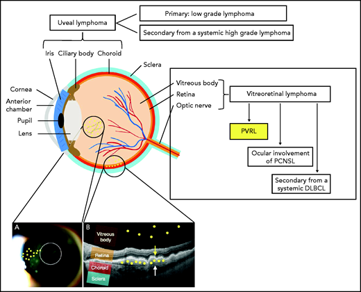 Schema of the anatomy of the eye and anatomical classification of intraocular lymphoma (IOL). IOL can occur in the uveal tract (iris, ciliary body, and choroid) as a primary (mainly mucosa-associated lymphoid tissue lymphoma) or secondary (to systemic lymphoma) form. IOL that occurs in the vitreous body, the retina, or in rare cases the optic nerve is called vitreoretinal lymphoma (VRL). VRL is subdivided into PVRL, ocular involvement of PCNSL, and secondary lymphoma from systemic diffuse large B-cell lymphoma (DLBCL). The typical localization of lymphoma cells in the case of PVRL is represented by the small yellow circles drawn on the picture. (A) Slit-lamp examination of an eye affected by PVRL showing the infiltration of lymphoma cells in the anterior vitreous and along the vitreous fibrils. (B) Optical coherence tomography (OCT) image of the retina illustrating the infiltration of lymphoma cells into the subretinal space between the retinal pigmented epithelium (yellow arrow) and the Bruch membrane (white arrow) or into the vitreous body.