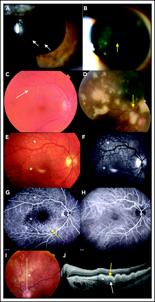 Ophthalmological findings and multimodal imaging of PVRL. (A) Slit-lamp examination showing a quiet anterior chamber with no protein flare and some cellular gray diffuse keratic precipitates (white arrows). (B) A clump of lymphoma cells is visible in the slit-lamp examination in the anterior vitreous or along the vitreous fibrils (yellow arrow). (C) At diagnosis, a fundus examination reveals only subtle small yellowish retinal lesions (white arrow). (D) The (sub)retinal lesions detected at diagnosis are more extended and multifocal (yellow arrow; composite color fundus photograph, with photos merged together with built-in camera software) (E) Retinal photograph showing cream-colored subretinal deposits (white asterisks). (F) Infrared photograph of the same patient shown in panel E, showing hyperreflective lesions corresponding to the lesions visible in panel E (white asterisks). (G) Fluorescein angiography of the same patient shown in panel E, showing the lymphoid infiltration as dark spots masking the underlying fluorescence of the choroid (white asterisks). RPE alterations appear as hyperfluorescent areas because of window effects (yellow arrow). (H) Indocyanine angiography of the same patient shown in panel E, with poorly contributive hypocyanescent lesions visualized. (I) Fundus photograph showing patchy yellowish subretinal lesions (white asterisk). (J) OCT image of the retina along the white line in panel I showing subretinal hyperreflective deposits of lymphoma cells (white asterisk) that are located between the RPE (yellow arrow) and the Bruch membrane (white arrow).