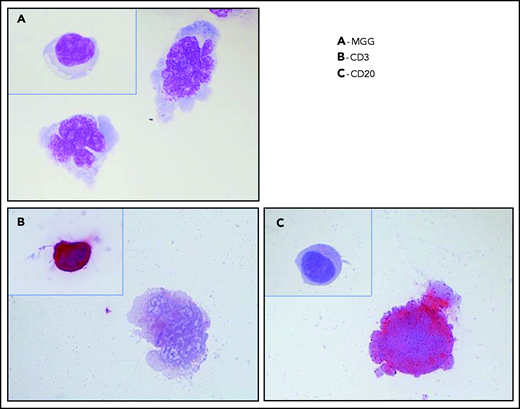 Typical cytology of vitreoretinal lymphoma. Reconstruction from 4 fields of the same cytospin (magnification x100 m) (A) May-Grünwald-Giemsa (MGG) staining of a diluted vitrectomy specimen. Cytospin shows 2 large lymphoid cells with basophilic cytoplasm and irregular nuclei, with several nucleoli corresponding to large lymphomatous cells. A small reactive lymphocyte (inset) was visible on another field of the same cytospin. (B) Immunochemistry with an anti-CD3 antibody and alkaline phosphatase–antialkaline phosphatase (APAAP) staining showing the negativity of a large lymphoma cell and the positivity of a reactive lymphocyte (inset). These 2 cells were identified in 2 different fields on the same cytospin. (C) Immunochemistry with an anti-CD20 antibody and APAAP staining showing the positivity of a large lymphoma cell and the negativity of a reactive lymphocyte (inset). These 2 cells were identified in 2 different fields on the same cytospin.