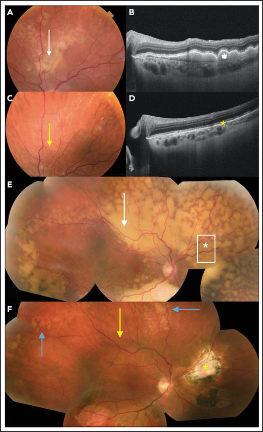 Clinical evaluation of the response to treatment of PVRL. (A) Retinal photograph of a subretinal yellowish lesion corresponding to the lymphoma lesion before treatment (white arrow). (B) OCT image of the lesion described in panel A showing hyperreflective subretinal deposits (white star). (C) After systemic treatment, the subretinal lesion completely disappeared in the retinal photograph (yellow arrow). (D) In the OCT image, the subretinal deposits also disappeared (yellow asterisk). (E) In another patient, composite color fundus photograph (photographs merged together with built-in camera software) shows diffuse subretinal yellowish lesions corresponding to (sub)retinal infiltration by lymphoma cells captured before treatment (white arrow). In this patient, the vitreous was clear and free of visible lymphoma cells. The vitreous levels of IL-10 and IL-6 were low (36 and 6 pg/mL, respectively). A retinal biopsy was performed in the area of the asterisk to assess the diagnosis in this patient with pure retinal lymphoma. (F) Composite color fundus photograph (photographs merged together with built-in camera software) of patient shown in panel E after 2 courses of systemic chemotherapy (rituximab, HD MTX, procarbazine, and vincristine), showing the disappearance of most of the lesions (yellow arrow). The residual active lesions (blue arrows) disappeared after subsequent courses of chemotherapy. The scar from the retinal biopsy performed during diagnostic vitrectomy is visible on the nasal side of the optic nerve (yellow asterisk).