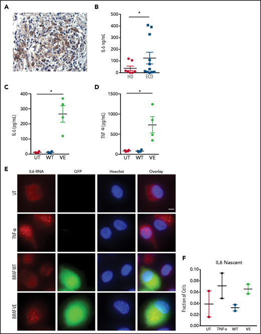Spontaneous cytokine production by macrophages expressing BRAFV600E. (A) Immunohistochemistry staining of an ECD biopsy specimen (lung lesion) showing IL-6 expression by infiltrating macrophages. Original magnification ×400. (B) Spontaneous production of IL-6 by circulating monocytes of patients with ECD compared with healthy controls. Bars indicate mean ± SEM; biological duplicates were performed for each condition. (C-D) Spontaneous production of IL-6 (C) and TNFα (D) by nontransduced macrophages (UT) or macrophages expressing wtBRAF (WT) and BRAFV600E (VE). Data are shown as the mean ± SEM (n = 4); biological duplicates were performed for each condition. (E) Representative smFISH images using probes targeted to IL6 mRNA; IL6 RNAs appear as scattered dots in the cell cytosol, whereas nascent mRNAs appear as 1 to 2 bright dots in the cell nucleus. Scale bar, 5 µm. (F) Quantification of cells with visible nascent IL6 mRNAs. *P < .05, Student t test (B-D).