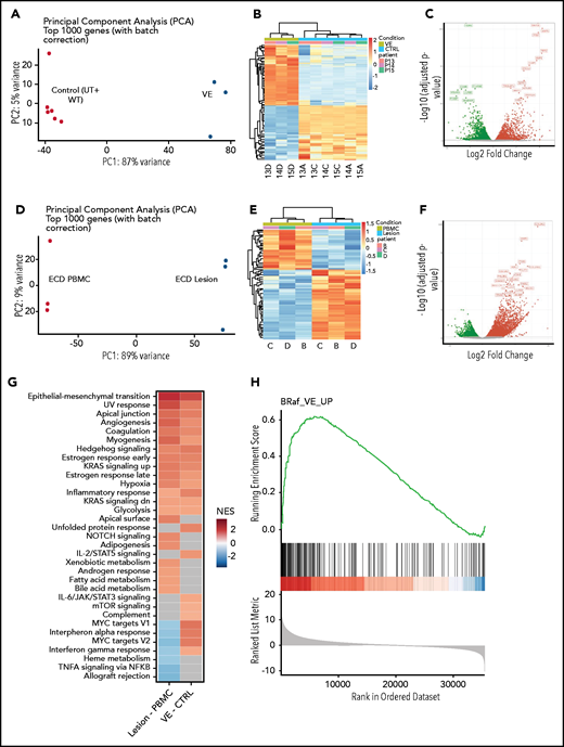 Global gene expression analysis in macrophages expressing BRAFV600E and in ECD lesion tissue. (A) Principal component analysis (PCA) of transcriptional profiles of primary human macrophages or of macrophages transduced with wtBRAF and BRAFV600E 6 days after transduction. (B) Unsupervised clustering analysis of DEGs in macrophages expressing BRAFV600E compared with controls (native and transduced with wtBRAF combined). (C) Volcano plots highlighting significant downregulated (green) and upregulated (red) genes in macrophages expressing BRAFV600E compared with controls (native and transduced with wtBRAF combined). (D) PCA of transcriptional profiles of matched PBMCs and ECD lesions from patients carrying the BRAFV600E mutation. (E) Unsupervised clustering analysis of DEGs in matched PBMCs and ECD lesions from patients carrying the BRAFV600E mutation. (F) Volcano plots highlighting significant downregulated (green) and upregulated (red) genes in matched PBMCs and ECD lesions from patients carrying the BRAFV600E mutation. (G) GSEA against Hallmark Gene Sets from Molecular Signatures Database (v7.1) showing enriched gene signatures identified in ECD lesions compared with matched PBMCs from patients (left) and in macrophages carrying BRAFV600E compared with controls (native and transduced with wtBRAF combined; right); NES, normalized enrichment score. (H) GSEA plot graph showing the concordance of the top upregulated gene signatures identified in macrophages carrying BRAFV600E compared with controls (native and transduced with BRAFwt combined) and in ECD lesions compared with matched PBMCs from patients.