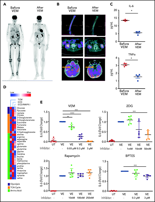 Therapeutic targeting of TI suppresses inflammation in ECD. (A) FDG-PET studies showing uptake of glucose by ECD lesions at baseline (left) and after clinical treatment with the selective BRAFV600E inhibitor vemurafenib (VEM) at a dose of 480 mg daily for 3 months. (B) Details from the FDG-PET evaluation shown in panel A: femoral (top panel), retroperitoneal (middle panel), and pineal (bottom panel, arrow) lesions. (C) Serum cytokines before and after therapeutic inhibition of BRAFV600E with VEM at a dose of 480 mg daily for 3 months. Data are the mean ± SEM (n = 4); *P < .05, Mann-Whitney U test. (D) Metabolomics analysis on supernatants of an ECD lesion (skin biopsy specimen) cultured in bioreactor in the presence or absence of the MAPK pathway inhibitor (MAPKi) trametinib (GSK1120212, 1 nM); supernatants were retrieved for metabolite determination after 4 days of culture. TCM: tissue culture medium (baseline comparison). (E) Cytokine production measured in the supernatant of nontransduced macrophages (UT) or macrophages expressing BRAFV600E (VE) cultured in the presence or absence of different treatments for 48 hours. 2DG, glycolysis inhibitor; BPTES, bis-2-(5-phenylacetamido-1,3,4-thiadiazol-2-yl)ethyl sulfide (glutaminolysis inhibitor). Data are shown as means ± SEM (n = 6); biological duplicates were performed for each condition. **P < .01; ***P < .001; ****P < .0001, paired Student t test.