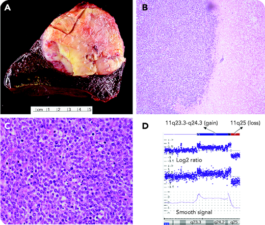 A 58-year-old man presented with a complaint of left flank pain. He had no significant past medical history. Laboratory study showed normal complete blood count and chemistry. Physical examination revealed splenomegaly, but no hepatomegaly or lymphadenopathy. CT scan showed a low-density mass in the posterior spleen, which raised suspicion for partially thrombosed hemangioma on magnetic resonance imaging. The patient underwent robotic splenectomy. Gross examination showed a well circumscribed mass measuring 8.5 cm in dimension (panel A). The histology showed sheets of tumor cells with monotonous appearance. They were small to intermediate in size with round nuclear contours, open chromatin and small but distinct nucleoli. Coagulative necrosis and frequent mitosis were seen (panels B and C, hematoxylin and eosin stain, original magnification ×100 and ×400, respectively). The cells were positive for CD20, BCL-6, MUM-1, and P53 protein but negative for CD3, CD5, CD10, BCL-1, BCL-2, and MYC protein by immunohistochemistry. Ki-67 (proliferation index) highlighted >95% of tumor cells. Fluorescence in situ hybridization analysis was negative for MYC/BCL-2/BCL-6 gene rearrangements but positive for 11q aberration, which was further confirmed by chromosomal microarray (panel D, chromosomal 11q23.3-q24.3 gain and 11q25 loss).