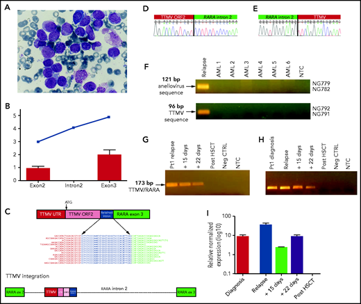 Morphologic features of the APL case and characterization of the TTMV/RARA chimeric fusion transcript. (A) Morphology of the case of APL, negative for RARA rearrangement. Nuclear size and shape are irregular, whereas the cytoplasm is for the most part occupied by densely packed granules. (B) Average relative expression level from WTS data of RARA exons 2 and 3, and the expressed intronic region is shown for the index case (blue squares) and for another 12 AMLs with known chromosomal aberrations. (C) Schematic representation of the fusion between the TTMV sequence and RARA exon 3. The chimeric transcript shows the conserved TTMV UTR sequence followed by the ORF2, immediately upstream of the short sequence of retained RARA intron 2, in frame with the full RARA exon 3. A new splicing event that joins this part of the retained intron 2 to exon 3 and removes the intervening intronic sequence occurs during splicing. Some representative sequencing reads that support the presence of the fusion transcript are shown. The exon–intron gene structure and the location of the integrated viral sequence is indicated at the bottom. (D-E) Sanger sequencing electropherograms of the downstream (D) and upstream (E) breakpoints of TTMV integration on the leukemia relapse sample genomic DNA. (F) Detection of viral integration with primers common to the 3 Anelloviruses TTV, TTMDV, and TTMV (NG779/NG782), and those specific only for TTMV (NG792/NG791), in genomic DNA of the relapsed APL case and in another 6 AML samples. (G-H) Detection of the TTMV/RARA chimeric fusion in genomic DNA (G) and cDNA (H) in sequential samples of the APL case from diagnosis to relapse, during remission–induction therapy, and after HSCT. (I) Quantitative real-time PCR detection of the TTMV/RARA fusion transcript decrease during induction therapy and after HSCT.