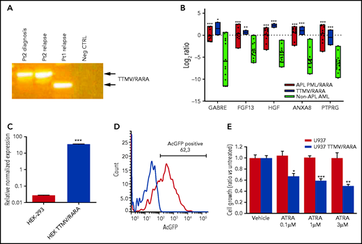 Phenotypic characterization of TTMV/RARA fusion transcript. (A) Detection of the TTMV/RARA chimeric fusion in cDNA of patient 2 diagnosis and relapse and of the index case for comparison. Patient 2 carried a longer insert sequence from TTMV ORF2, with respect to the index case (Pt1). (B) Overexpression of the top-scoring M3-AML–specific genes in the 2 cases carrying TTMV-RARA chimeric fusion (blue bars) similarly to the 11 APL cases from the SRA bioproject PRJNA721935 (red bars) and with respect to another 15 non-APL AML samples lacking cytogenetic and molecular aberrations (light green bars). The plot reports gene expression quantification as log2 ratios of transcripts per kilobase million (TPM); P value vs non-APL AML: *P < .05; **P < .01; ***P < .001. (C) Expression of TTMV-RARA by quantitative PCR in the HEK-293 cell line either parental or transfected with cloned full-length TTMV-RARA fusion transcript: P < .0001. (D) Flow cytometry assessment of TTMV/RARA fusion protein expression evaluated by means of AcGFP positivity in HEK-293 cells transfected with cloned full-length TTMV-RARA in frame with the AcGFP fluorescent tag sequence. (E) Effect of different ATRA concentrations on cell growth of U937 cells transfected with cloned full-length TTMV-RARA compared with the parental cell line after 4 days of treatment (*P < .05; **P < .01; ***P < .001).