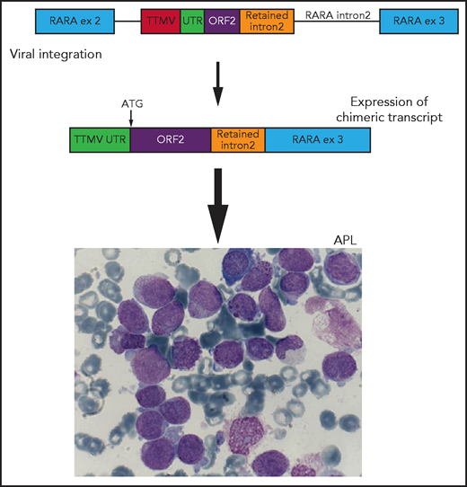 Schematic representation of viral integration of a portion of the TTMV gene into intron 2 of the RARA gene. The integration includes TTMV open reading frame 2 (ORF2) and an upstream untranslated region (UTR) adjacent to a short sequence of retained RARA intron 2, in-frame with exon (ex) 3. This integration results in the transcription of a chimeric fusion messenger RNA with a start codon (ATG) at the initiation of TTMV ORF2. This chimeric fusion transcript results in an APL-like gene expression signature and ultimately the development of acute promyelocytic leukemia (APL). Adapted from Figure 1 in the article by Astolfi et al that begins on page 1773.