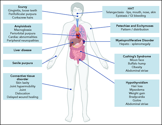 Clinical features associated with inherited and acquired causes of mild to moderate mucocutaneous bleeding. HHT, hereditary hemorrhagic telangiectasia.