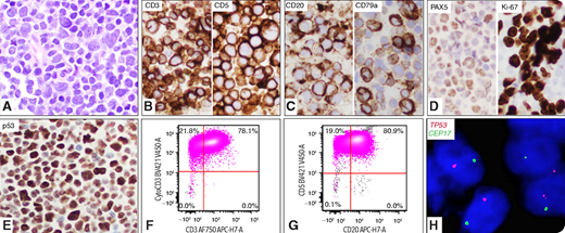 A 59-year-old woman presented with lymphadenopathies. A lymph node biopsy revealed intermediate- to large-sized blastoid cells with round to irregular nuclei, fine chromatin, and small inconspicuous nucleoli (panel A; original magnification: ×40 objective; ×400 total magnification). By immunohistochemistry, the neoplastic cells were positive for CD3, CD5, CD20, CD79a, PAX5, Ki67, and p53 (panels B-E; original magnification: ×40 objective; ×400 total magnification). Flow cytometric analysis showed aberrant T cells: positive for CD2, CD3 (panel F; surface and cytoplasmic), CD4, CD5, CD20 (panel G), TCRα/β, and negative for CD34, TDT, CD1a, CD7, CD8, CD10, CD30, TCRγ/δ, CD19, and CD22. Molecular studies detected monoclonal TCR β and γ gene rearrangements but no IGH rearrangement. Fluorescence in situ hybridization using dual-color TP53/CEP17 probes detected monosomy 17 in 88% of cells (panel H; original magnification: ×60 objective; ×600 total magnification). A 162-gene lymphoma mutation assay by next-generation sequencing revealed TP53 mutation (variant allele frequency = 80%). She was diagnosed with peripheral T-cell lymphoma (PTCL), not otherwise specified, and was treated with chemotherapy with poor response. She died of disease in 5 months.