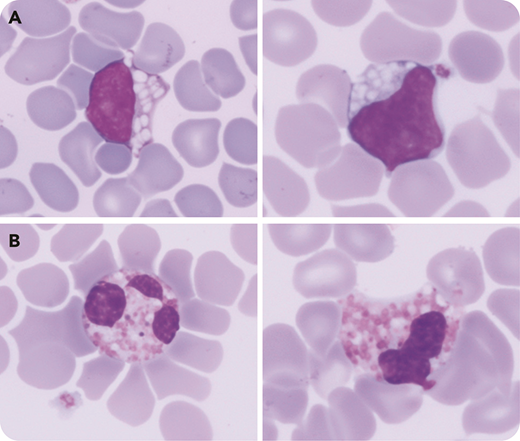 A routine blood count was performed in a premature boy (35 weeks’gestation) at day 2 of life revealing only a mild thrombocytopenia (platelets, 145 × 109/L) associated with an abnormal lymphocytes/blasts alarm (Sysmex XN-3000). Examination of a May-Grünwald Giemsa–stained blood smear showed numerous lymphocytes with large vacuoles (75%) (panel A, original magnification ×1000) associated with hypogranulated eosinophils and variable tinctorial affinity (panel B, original magnification ×1000). In general, such atypical lymphocytes are evocative of lysosomal storage disorder, but their association with these abnormal eosinophils is highly specific of GM1 gangliosidosis (Landing disease). Despite the absence of clinical signs or family history (consanguinity), this cytology encouraged clinicians to investigate further. A urine sample revealed GM1 ganglioside elevation with traces of GM2 ganglioside. Biochemical investigation and molecular analysis confirmed type 1 GM1 gangliosidosis with total enzymatic deficiency of β-galactosidase in leukocytes, as well as an undescribed homozygous mutation (c.819delG) on GLB1.