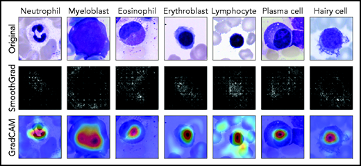 Network prediction analysis shows focus on relevant image regions. Original images classified correctly by the network are shown in the top row. As detailed in the main text, all cells were stained using the May-Grünwald-Giemsa/Pappenheim stain, and imaged at ×40 magnification. The middle row shows analysis using the SmoothGrad algorithm. The lighter a pixel appears, the more it contributes to the classification decision made by the network. Results of a second network analysis method, the Grad-CAM algorithm, are shown in the bottom row as a heat map overlaid on the input image. Image regions containing relevant features are colored red. Both analysis methods suggest that the network has learned to focus on the leukocyte while ignoring background structure. Note the attention of the network to features known to be relevant for particular classes, such as the cytoplasmic structure in eosinophils or the nuclear configuration in plasma cells.