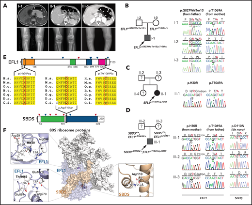EFL1 variants in SBDS− SDS patients. (A) Noncontrast T1-weighted abdominal magnetic resonance (I-1) or computed tomography images (II-1 and III-1) showing a diffuse enlargement with lipomatosis of the pancreas (arrows; upper) and both knees with metaphyseal widening and irregularities in the femora in the 3 patients and associated genu varum in III-1 (lower). (B-D) Pedigrees and Sanger sequencing traces showing the inherited EFL1 variants and the de novo SBDSp.Asp110Asn variant in the 3 families. DNA was extracted from whole-blood samples. Note that the lower-case nucleotide letters were used on top of the Sanger traces to reflect their minor allelic representation in the patient samples. (E) The residues with nonsynonymous changes in EFL1 and SBDS are evolutionarily conserved. The arrowheads on the protein maps denote previously reported pathogenic variants (blue, missense; red, loss of function). (F) Molecular modeling–based structural analysis using PDB 5ANC.7 The insets show the detailed interactions involving EFL1 His30, Thr1069, and SBDS Asp110. B.t., Bos taurus; C.i., Ciona intestinalis; D.r., Danio rerio; G.g., Gallus gallus; H.s., Homo sapiens; M.m., Mus musculus; O.c., Oryctolagus cuniculus.