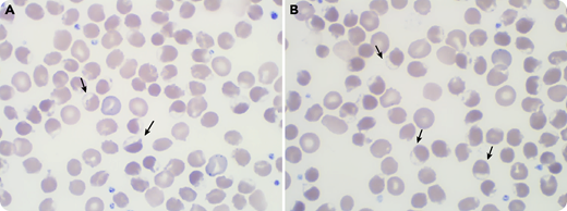 A 71-year-old white man was admitted for jaundice without fever or abdominal pain. He had received his last dose of durvalumab 2 months earlier for non–small cell lung cancer, and a first dose of anti–SARS-CoV-2 (severe acute respiratory syndrome coronavirus 2) vaccine a week earlier. The blood cell count revealed moderate anemia (120 g/L) with poikilocytosis and many bite cells (panels A-B; black arrows; original magnification ×100) on the peripheral blood smear. Within 48 hours, hemoglobin (Hb) had dropped to 48 g/L with a high reticulocyte count (250 × 109/L) and signs of hemolysis (hyperbilirubinemia: 208 µmol/L; lactate dehydrogenase: 983 U/L; haptoglobin: <0.01 g/L). Direct agglutination test (DAT) was negative. He was admitted in the intensive care unit for aspiration pneumonia, acute renal failure, and altered mental status. After a massive red blood cell infusion, the evolution was favorable. He was diagnosed with glucose-6-phosphate dehydrogenase (G6PD) deficiency with a very low G6PD rate: 0.8 UI/g Hb (reference: 11-17 UI/g).