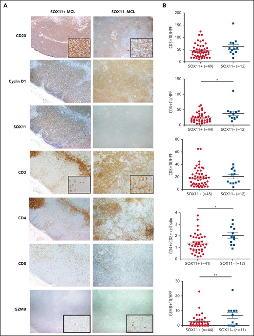 Decreased infiltration of CD3+, CD4+, and granzyme-B+ tumor-infiltrating lymphocytes (TILs) in SOX11+ compared with SOX11− nodal MCL primary cases. (A) Representative histological sections from SOX11+ and SOX11− nodal MCLs stained with specific anti-human CD20, cyclin D1, SOX11, CD3, CD4, CD8, and granzyme B (GZMB) antibodies (×40). Pictures contain insets with magnification (×200). (B) IHC quantifications of CD3+, CD4+, CD8+, and GZMB+ TILs and CD4+/CD8+ T-cell ratio in SOX11+ and SOX11− nodal MCLs. The significance of difference was determined by independent-samples Student t test: *P < .05, **P < .01. HPF, number of cells per high-power field (×400).
