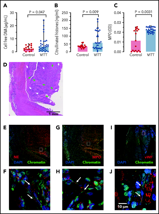 NETs in VITT patient cerebral sinus vein thrombi. (A) Cell-free DNA serum levels of VITT patients and controls using fluorescent DNA-intercalating dye Sytox Green. Statistical comparison by unpaired Student t test; (B) Serum citrullinated histone H3 (CitH3) levels in VITT patients and healthy controls measured by ELISA. Statistical comparison by unpaired Student t test; (C) Serum MPO levels in VITT patients and healthy controls quantified using an ELISA. Mann-Whitney nonparametric test compared the 2 groups. (D) Hematoxylin and eosin (H&E) stained histologic section of a cerebral venous sinus thrombus of a VITT patient. Arrows indicate amorphous fibrin (green) and granulocyte-rich areas (white) in the thrombus core, respectively (E-J). Immunohistochemistry images of the VITT patient cerebral sinus vein thrombus shown in panel A. The section assessed in more detail in panels C, E, and G are given as small rectangles in panels B, D, and F. Markers for NETs and neutrophils include NE (red) in panels E and F, and MPO (red) in panels G and H. Von Willebrand factor (vWF, red) is shown in panels I and J for comparison. DAPI stains DNA in blue while chromatin (antihistone H2A/H2B/DNA-complexes) is shown in green.