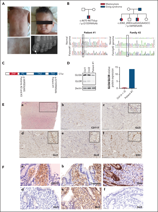 Clinical and biological features of a patient with GCPS and CM. (A) Patient 1: diffuse CM, macrocephaly, and polydactyly. (B) Pedigrees and mutations of the 3 patients. (C) Structure of GLI3 protein. (D) Immunoblots of GLI3 with fibroblast extracts from patient 1 and 2 healthy controls; relative quantification of GLI3A/GLI3R ratio. (E) Histology showing MC infiltration throughout the dermis of patient 1 (a). Cell infiltrates are positive for CD117 (b), negative or weakly positive for GLI3 (c), positive for GLI1 notably in the nucleus (d), weakly positive for GLI2 (e), and strongly positive for SHH (f). (Fa-f) Histology showing MC infiltration throughout the digestive tract of patient 1 and immunostaining with the same antibodies as for skin. (E-F) Original magnification, ×10 and ×30 (insets).