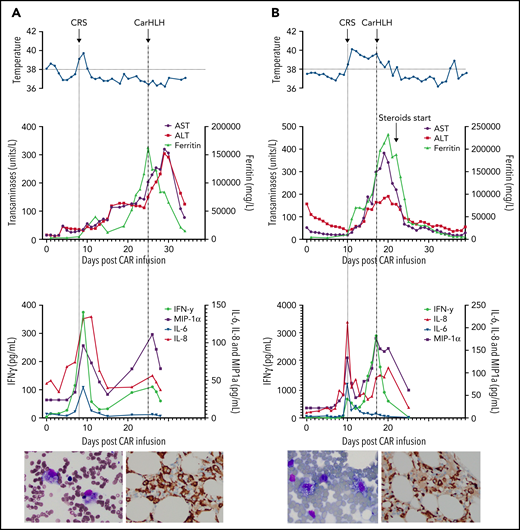 Representative series of carHLH manifestations in select patients. (A) Subject develops grade 1 CRS on day +8 following CD22 CAR T-cell infusion and was treated with supportive care only, without pharmaceutical intervention. Despite full resolution of manifestations at the time, he progresses to develop hyperferritinemia and transaminitis, corresponding with carHLH, but was otherwise systemically well without evidence for fever/hypotension. Cytokine profiling reveals a secondary peak of IFNγ, MIP-1α, and IL-8, but IL-6 remains low. Bone marrow at restaging demonstrates an MRD− complete remission with evidence for increased macrophages without hemophagocytosis. Left image: modified Giemsa stain (50 ×/10, oil lens) of bone marrow aspirate shows increased macrophages. Right image: CD163 immunohistochemical staining of bone marrow core biopsy (brown) highlights increased macrophages, some containing hemosiderin; no hemophagocytosis present (counterstained with hematoxylin). (B) Subject develops CRS on day +10 following CAR T-cell infusion, reaches max CRS grade 2. CRS manifestations (fevers) were resolving without intervention of tocilizumab or steroids, and corresponding cytokine profiling reveals rise and fall in all 4 cytokines that are profiled. In the context of CRS, carHLH symptoms start to manifest. Ferritin progressively increases followed by transaminitis prompting brief steroid utilization (<48 hours), leading to resolution of manifestations (some of which were already declining), however was given in the context of worsening cytopenias (not shown). Again, a secondary peak of select cytokines, including IFNγ, MIP-1α, and IL-8 is seen, but IL-6 remains low. Bone marrow at restaging demonstrates an MRD-negative complete remission with evidence for increased macrophages without hemophagocytosis. Modified Giemsa stain (50 ×/10, oil lens) of bone marrow aspirate shows 2 macrophages, of which 1 contains hemosiderin pigment (left); CD163 immunohistochemical staining of bone marrow core biopsy (brown) highlights increased macrophages in a hypocellular marrow. No hemophagocytosis present (counterstained with hematoxylin). (C) Subject develops CRS on day +5 and has several days of fever and an initial rise in cytokines (max CRS grade 2) with resolution. However, 48 hours later there is a recrudescence of fevers and with ongoing and higher fevers, tocilizumab and subsequently steroids are administered. In this more complicated patient, fever is ongoing with the onset of carHLH, showing an example where manifestations clearly overlap. However, elevations in ferritin mirror elevations in IFNγ (samples upper limit was 2860 pg/mL, and diluted levels were substantially higher). Bone marrow at restaging demonstrates a very hypocellular marrow with an MRD− complete remission with evidence for active hemophagocytosis (which resolved on a subsequent evaluation). Left image: modified Giemsa stain (50 ×/10, oil lens) of bone marrow aspirate shows hemophagocytic macrophages; right image: CD163 immunohistochemical staining of bone marrow core biopsy (brown) highlights increased macrophages with hemophagocytosis (counterstained with hematoxylin).