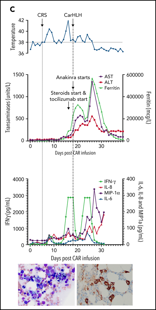 Representative series of carHLH manifestations in select patients. (A) Subject develops grade 1 CRS on day +8 following CD22 CAR T-cell infusion and was treated with supportive care only, without pharmaceutical intervention. Despite full resolution of manifestations at the time, he progresses to develop hyperferritinemia and transaminitis, corresponding with carHLH, but was otherwise systemically well without evidence for fever/hypotension. Cytokine profiling reveals a secondary peak of IFNγ, MIP-1α, and IL-8, but IL-6 remains low. Bone marrow at restaging demonstrates an MRD− complete remission with evidence for increased macrophages without hemophagocytosis. Left image: modified Giemsa stain (50 ×/10, oil lens) of bone marrow aspirate shows increased macrophages. Right image: CD163 immunohistochemical staining of bone marrow core biopsy (brown) highlights increased macrophages, some containing hemosiderin; no hemophagocytosis present (counterstained with hematoxylin). (B) Subject develops CRS on day +10 following CAR T-cell infusion, reaches max CRS grade 2. CRS manifestations (fevers) were resolving without intervention of tocilizumab or steroids, and corresponding cytokine profiling reveals rise and fall in all 4 cytokines that are profiled. In the context of CRS, carHLH symptoms start to manifest. Ferritin progressively increases followed by transaminitis prompting brief steroid utilization (<48 hours), leading to resolution of manifestations (some of which were already declining), however was given in the context of worsening cytopenias (not shown). Again, a secondary peak of select cytokines, including IFNγ, MIP-1α, and IL-8 is seen, but IL-6 remains low. Bone marrow at restaging demonstrates an MRD-negative complete remission with evidence for increased macrophages without hemophagocytosis. Modified Giemsa stain (50 ×/10, oil lens) of bone marrow aspirate shows 2 macrophages, of which 1 contains hemosiderin pigment (left); CD163 immunohistochemical staining of bone marrow core biopsy (brown) highlights increased macrophages in a hypocellular marrow. No hemophagocytosis present (counterstained with hematoxylin). (C) Subject develops CRS on day +5 and has several days of fever and an initial rise in cytokines (max CRS grade 2) with resolution. However, 48 hours later there is a recrudescence of fevers and with ongoing and higher fevers, tocilizumab and subsequently steroids are administered. In this more complicated patient, fever is ongoing with the onset of carHLH, showing an example where manifestations clearly overlap. However, elevations in ferritin mirror elevations in IFNγ (samples upper limit was 2860 pg/mL, and diluted levels were substantially higher). Bone marrow at restaging demonstrates a very hypocellular marrow with an MRD− complete remission with evidence for active hemophagocytosis (which resolved on a subsequent evaluation). Left image: modified Giemsa stain (50 ×/10, oil lens) of bone marrow aspirate shows hemophagocytic macrophages; right image: CD163 immunohistochemical staining of bone marrow core biopsy (brown) highlights increased macrophages with hemophagocytosis (counterstained with hematoxylin).