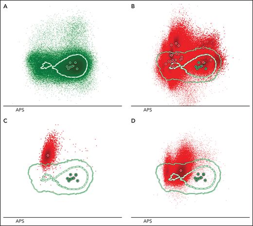 Sézary cells show heterogeneous phenotypes reflecting inter- and intrapatient diversity. (A) An automatic population separator (APS) plot based on all parameters included in the T-CLPD antibody panel showed the normal distribution of CD4+ T cells derived from 10 age- and sex-matched HCs (reference database). The green inner and outer lines represent, respectively, the first and second standard deviation of normal CD4+ T cells (green dots) and their corresponding population medians (larger green dots). (B) Phenotypically altered CD4+ T cells (red dots) from 24 patients with SS are depicted against the reference database and illustrate their heterogeneous and aberrant expression patterns compared with normal CD4+ T cells. Examples of 2 SS samples showing a tumor population with 1 homogeneous (C) or 2 immunophenotypically distinct (D) aberrancies.