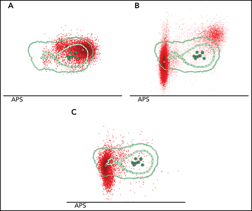 Sequential monitoring reveals shifts in Sézary cell immunophenotype correlated with disease progression. Three PB samples were collected at different disease stages from SS case 11. (A) The initial sample, isolated 6 months after diagnosis. MFC analysis showed 1 homogeneous tumor population characterized by the diminished expression of CD3 surface antigen. (B) The second PB sample was collected 16 months after diagnosis. At that time, the patient had experienced disease progression, and systemic treatment with CHOEP chemotherapy was initiated. Herein, the tumor population increased from 30% to 90% of the total CD4+ T-cell population, but this expansion was primarily based on the (dramatic) emergence of a novel Sézary cell tumor population characterized by a distinct immunophenotypic profile (CD3loCD4lo in combination with CD26negCD7negCD2lo) as compared with the preexisting tumor population, which was detectable but proportionally decreased over time. Treatment was insufficiently effective and was switched to mogamulizumab, a monoclonal antibody targeting CCR4. (C) At third sampling, 19 months after the first sample and now under treatment with mogamulizumab, the initial CD3lo tumor population was no longer detectable, and the newly emerged CD3loCD4lo tumor population was abundantly present compromising >90% of total CD4+ T cells.