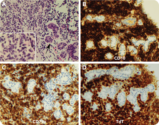 An 18-year-old woman presented with a gradually enlarging 9-cm breast mass that was firm but nontender without overlying skin changes. She was otherwise well without B symptoms or lymphadenopathy. A core biopsy was performed for clinical suspicion of giant fibroadenoma vs phyllodes tumor. Surprisingly, microscopy revealed a multifocal infiltrate of medium-sized apparent lymphoid cells with irregular nuclear contours, dispersed chromatin, and scant cytoplasm (panel A, hematoxylin and eosin stain; arrow, breast duct, with inset highlighting the infiltrating cell morphology; 60× objective/×780 total magnification for inset, 40× objective/×400 total magnification for main panel). Initial staining showed partial CD20 with strong CD10 expression, suspicious for precursor B cells (panel B, CD10 immunohistochemistry; 40× objective/×400 total magnification). This was confirmed by positive staining for CD19, PAX5, CD79a (panel C, CD79a immunohistochemistry; 40× objective/×400 total magnification), and TdT (panel D, TdT immunohistochemistry; 40× objective/×400 total magnification). Staging investigations ruled out blood or bone marrow involvement. The final diagnosis was therefore B-lymphoblastic lymphoma.