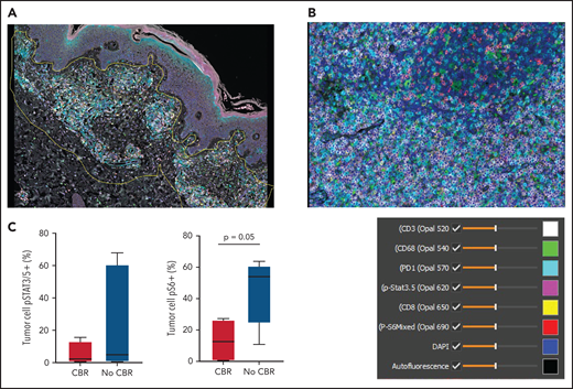 Multispectral immunofluorescence with 6 markers plus 4′,6-diamidino-2-phenylindole (DAPI) using the Vectra platform in pretreatment biopsies from 9 patients. (A) Spatial definition of the tumor involvement in a biopsy of MF using the HALO software. (B) Representative mIF image from a biopsy of PTCL stained as indicated. (C) Phospho-S6 expression in tumor cells distinguished patients with CBR or no CBR from ruxolitinib (P = .05). Phospho-STAT3/5 expression in tumor cells did not differ between patients with CBR or no CBR (P = .9).
