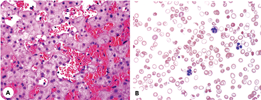 A 24-year-old man with sickle cell anemia and only 1 prior hospitalization presented in 2010 with increasing jaundice. Examination revealed intense jaundice and hepatomegaly. Hemoglobin was 7.2 g/dL; reticulocytes, 11%; ALT, 32 U/L; alkaline phosphatase, 573 U/L; and bilirubin 32, mg/dL overwhelmingly conjugated. Despite red blood cell (RBC) exchange transfusion (RBEX), bilirubin remained >30 mg/dL. Liver biopsy (panel A; hematoxylin and eosin stain, ×40 objective) showed marked sinusoidal dilatation with distention by numerous sickled RBCs. There was minimal canalicular cholestasis, focal mild ballooning degeneration of hepatocytes, scant reticuloendothelial iron, and focal mild perisinusoidal fibrosis, without hepatocyte necrosis or trabecular atrophy. In clinical context, the findings were interpreted as sickle cell intrahepatic cholestasis. Notwithstanding regular outpatient RBEX and supportive measures for 10 years, liver disease progressed to cirrhosis, ascites, and encephalopathy. Even with posttransfusion hemoglobin A >90% and functional asplenia, spur cells emerged (panel B; Wright Giemsa stain, ×60 objective). The patient is now recovering from a liver transplant.