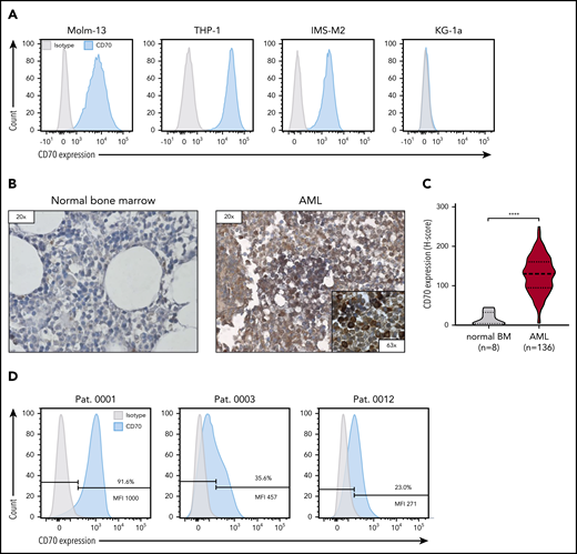CD70 expression of AML cell lines and primary bone marrow samples from patients with AML. (A) Evaluation of CD70 expression in several primary AML cell lines by flow cytometry. (B) Representative images of immunohistochemical staining for CD70 expression of bone marrow samples derived from patients without AML (normal bone marrow) and patients with newly diagnosed AML. Leukemic blasts in patients with AML were identified by their morphology. (C) Comparison of CD70 expression in bone marrow samples of 136 patients with AML and 8 individuals with normal bone marrow findings by immunohistochemical staining. The H-score was used to determine the staining intensity. ****P < .0001, by unpaired Student t test. (D) Analysis of CD70 expression in bone marrow samples of patients with newly diagnosed AML by flow cytometry. Percentage of CD70-expressing cells and median fluorescence intensity (MFI) of the CD70-positive cell population are depicted.