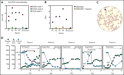 Anti-PF4 autoantibodies were detected in all samples by ELISA but not CLIA. (A) ELISA reactivity was inhibited to optical density <0.3 by heparin in all samples (2 U/mL, data not shown). (B) Binding of antibodies from patient sera to healthy donor platelets in the presence of AZD1222 was suppressed by heparin. Fluorescent intensity ratio of AZD1222 (or AZD1222 + heparin 100 U/mL) to buffer is shown. (C) Schistocytes in blood smear high power field in patient 1, indicative of TMA, on day 4. (D) Course of selected laboratory markers over time. X-axes show days of hospital stay. Y-axes on the left are for all panels.
